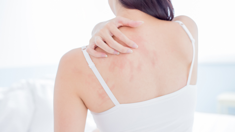 Why Did Older Man Develop Itchy, Full-Body Rash?