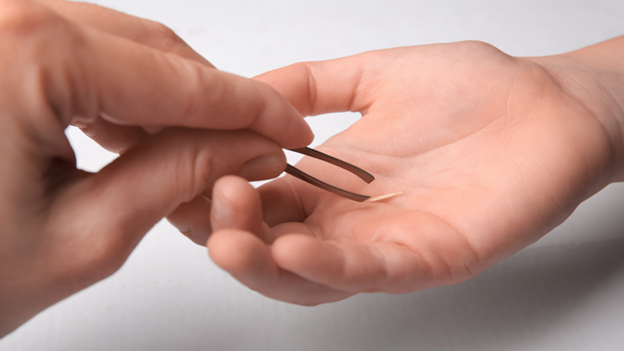 Person getting splinter removed at local urgent care