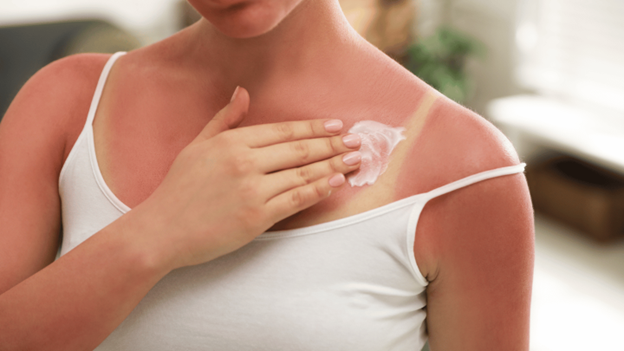 Woman applying soothing lotion to red sunburned skin on her shoulder and chest after sun exposure