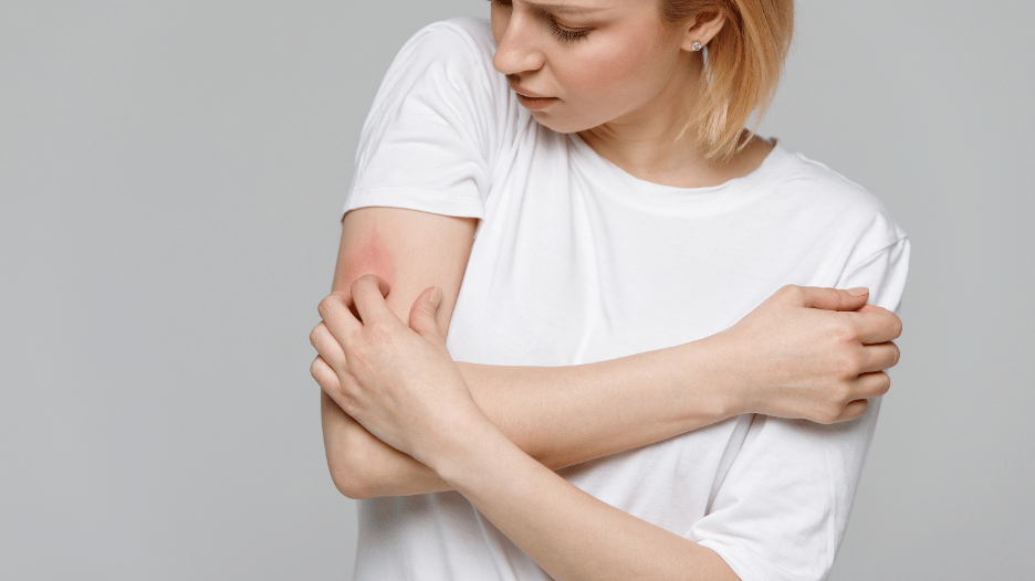 Woman scratching a spider bite on her arm