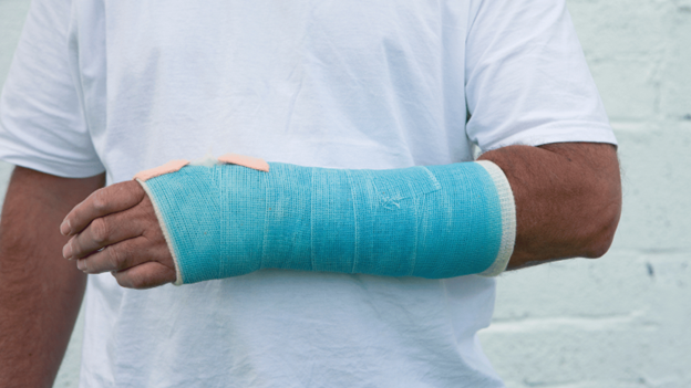 Person wearing blue wrist cast after a broken wrist injury